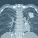 découvrez ce que signifie la présence d'une opacité pulmonaire sur un scanner, ses causes possibles et les implications pour votre santé pulmonaire.